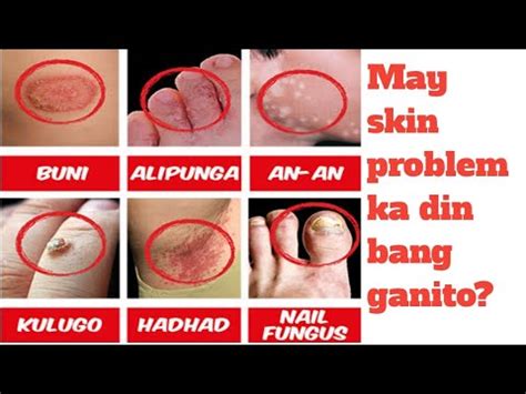finger sa pwet|Masakit Na Butas ng Puwet: Mga Dahilan at Paano Gamutin.